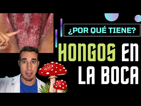 Tratamiento para hongos en la boca