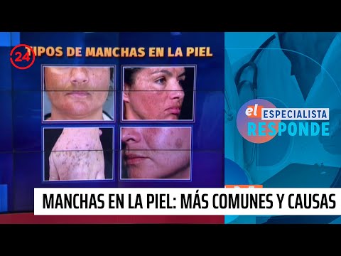 Tipos de manchas en la piel fotos