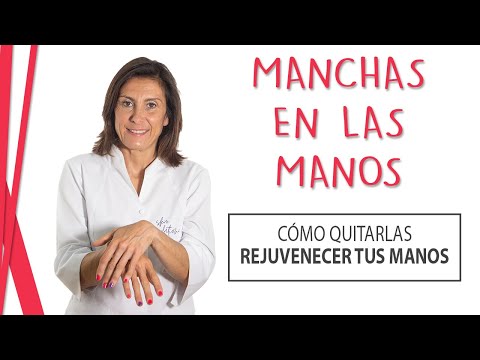 Manchas en las manos de repente