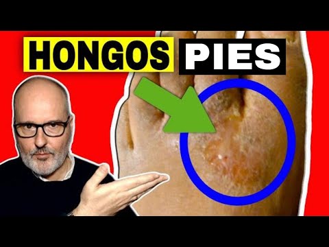 Tipos de hongos en los pies y como curarlos