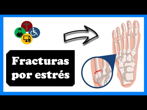 Fractura por estres tiempo de recuperacion