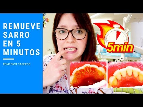 Como limpiar el sarro de los dientes