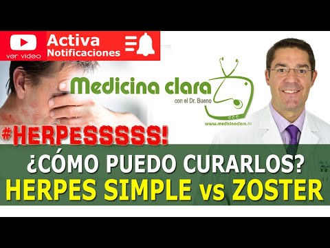 El mejor tratamiento para el herpes zoster