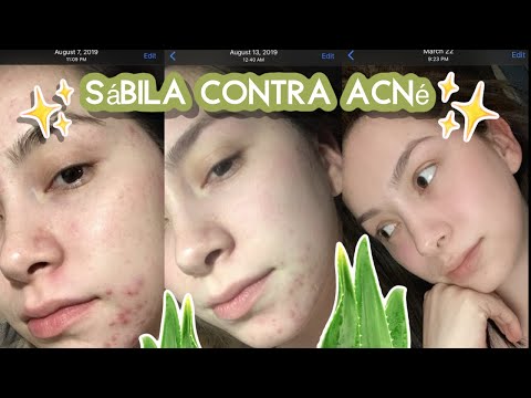 El aloe vera es bueno para el acne