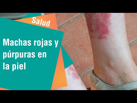 Manchas rojas en las piernas sin picor ni dolor