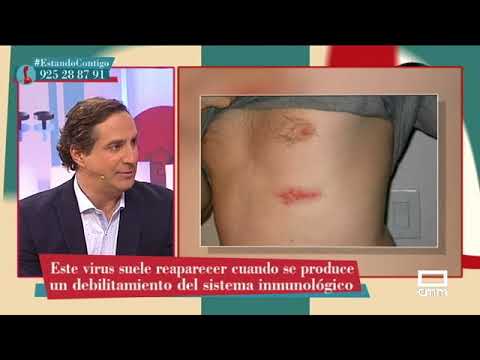 Tipos de herpes en la piel