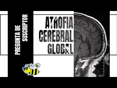 A que edad comienza la atrofia cerebral