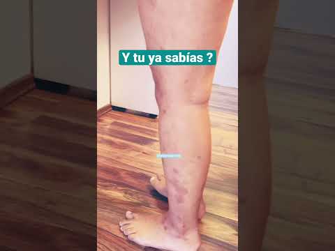 Tipos de manchas en las piernas