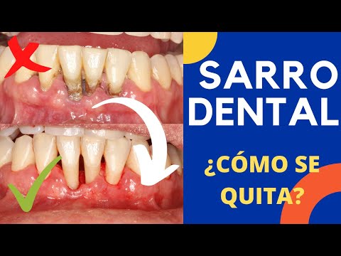 Como se quita el sarro de los dientes