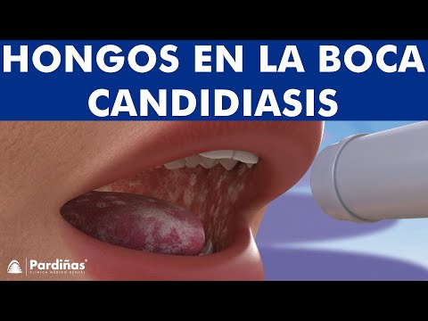 Hongos en la boca como curar