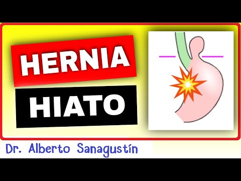 Sintomas de la hernia de hiato