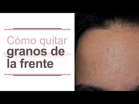 Como quitar granos de la frente