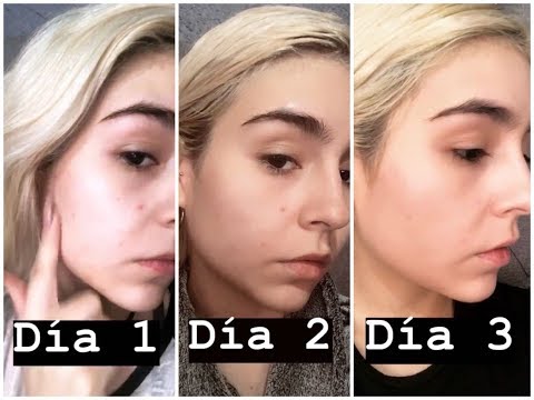 Curar el acne en 3 dias