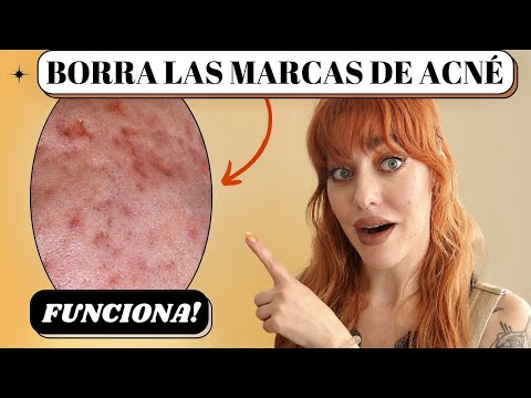 Como quitar manchas rojas de acne remedios caseros