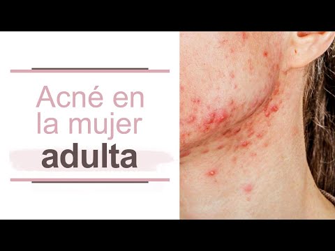 Granos en el cuello en mujeres