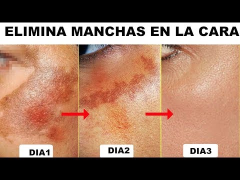 Como quitar manchas dela cara en 3 dias