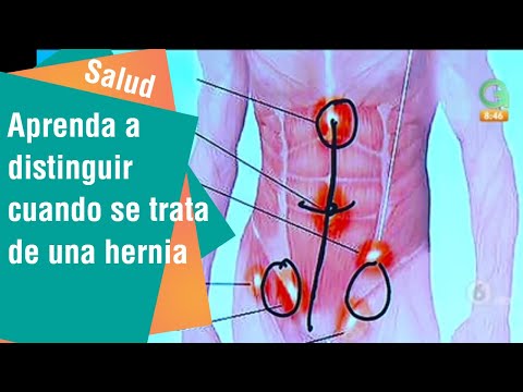 Tengo varios bultos en el abdomen