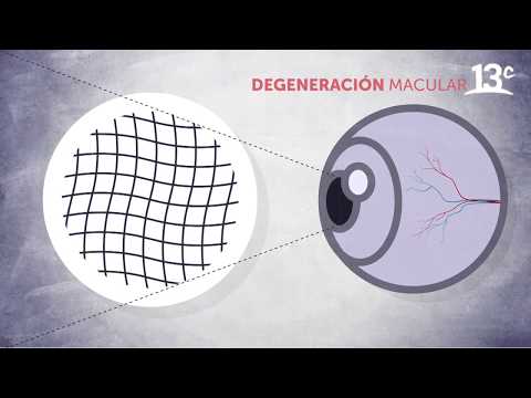 Como ve una persona con degeneracion macular