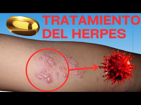 Cuanto tarda un herpes en irse con tratamiento