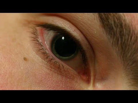 Como quitar las pupilas dilatadas por drogas
