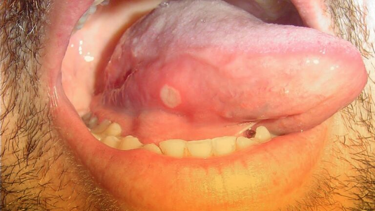 Diferencia entre aftas y hongos en la boca