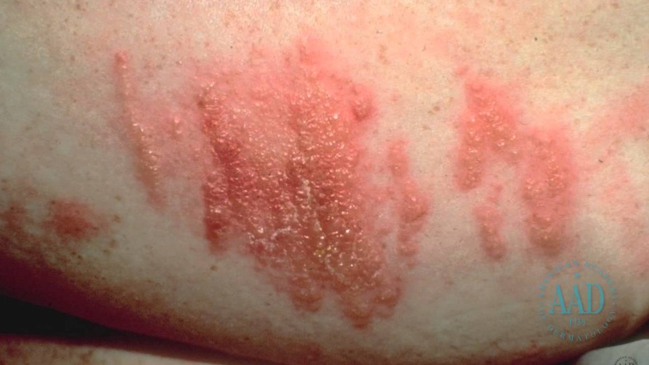 erupciones en la piel por estres