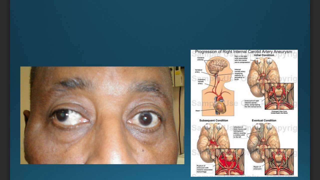 sintomas de un aneurisma cerebra